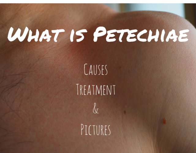 pinpoint-red-dots-on-skin-this-could-be-petechiae